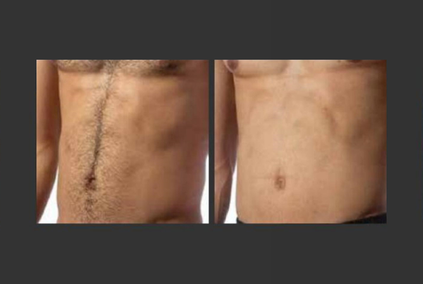 Abdomen