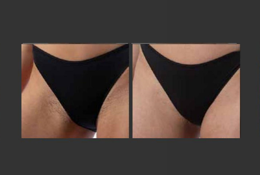 Bikinibereich