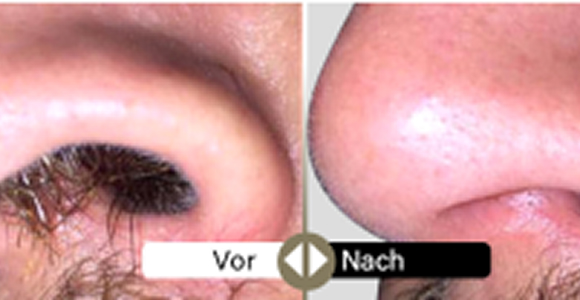 Deweon 4LD voher und nachher 1