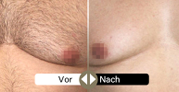 Deweon 4LD voher und nachher 2