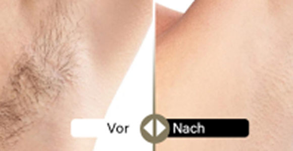 Deweon 4LD voher und nachher 3