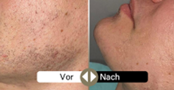 Deweon 4LD voher und nachher 4