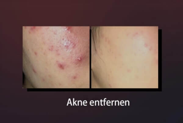 BBL Laser Vorher-Nachher zur Aknebehandlung im Gesicht
