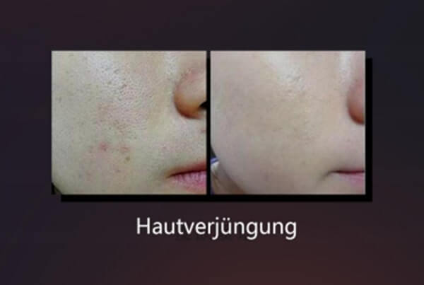 BBL Laser Hautverjüngung Vorher-Nachher im Gesicht