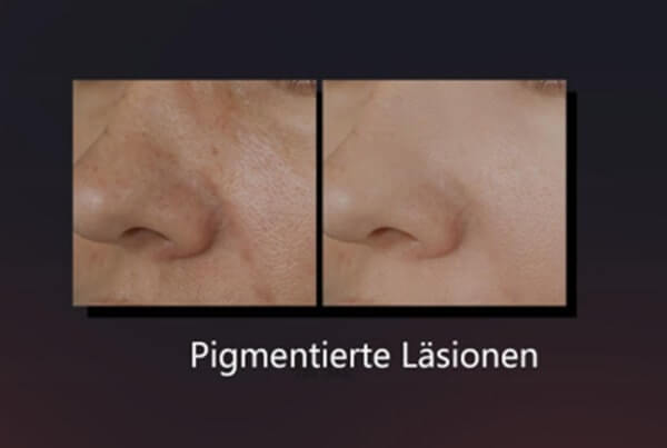 BBL Laser Vorher-Nachher bei Pigmentflecken an der Nase