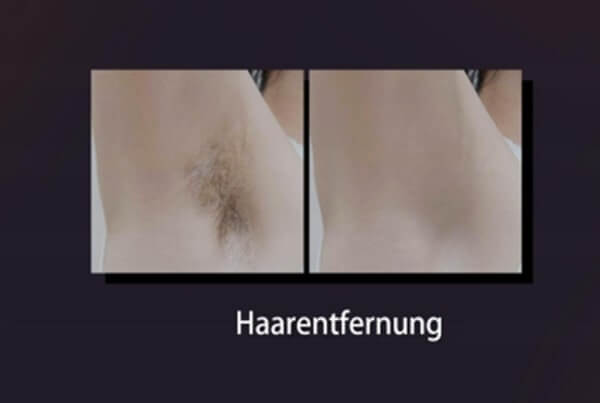 BBL Laser Vorher-Nachher bei Achselhaarentfernung